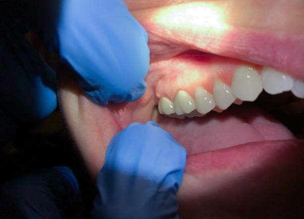 Best Emergency Dental Extractions in Sneads, FL