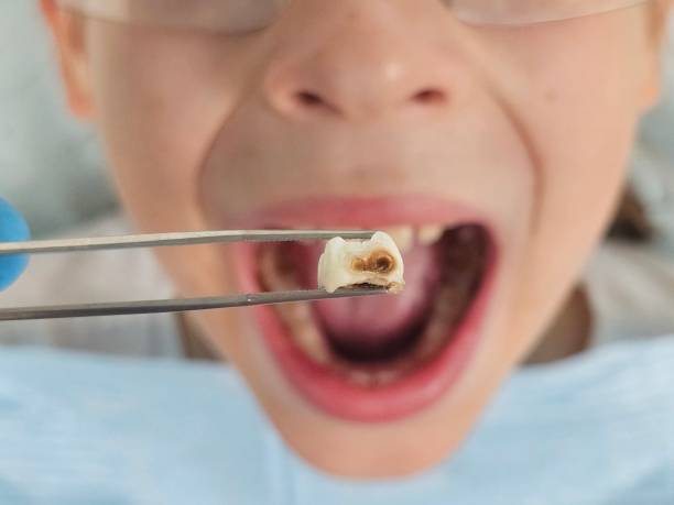 Best Emergency Dentist for Knocked-Out Tooth in Sneads, FL
